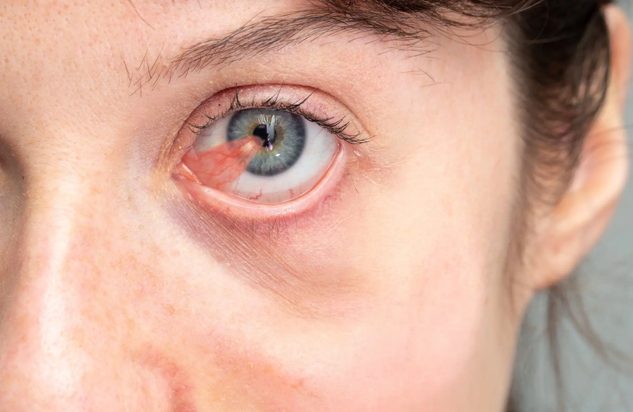 Pterygium