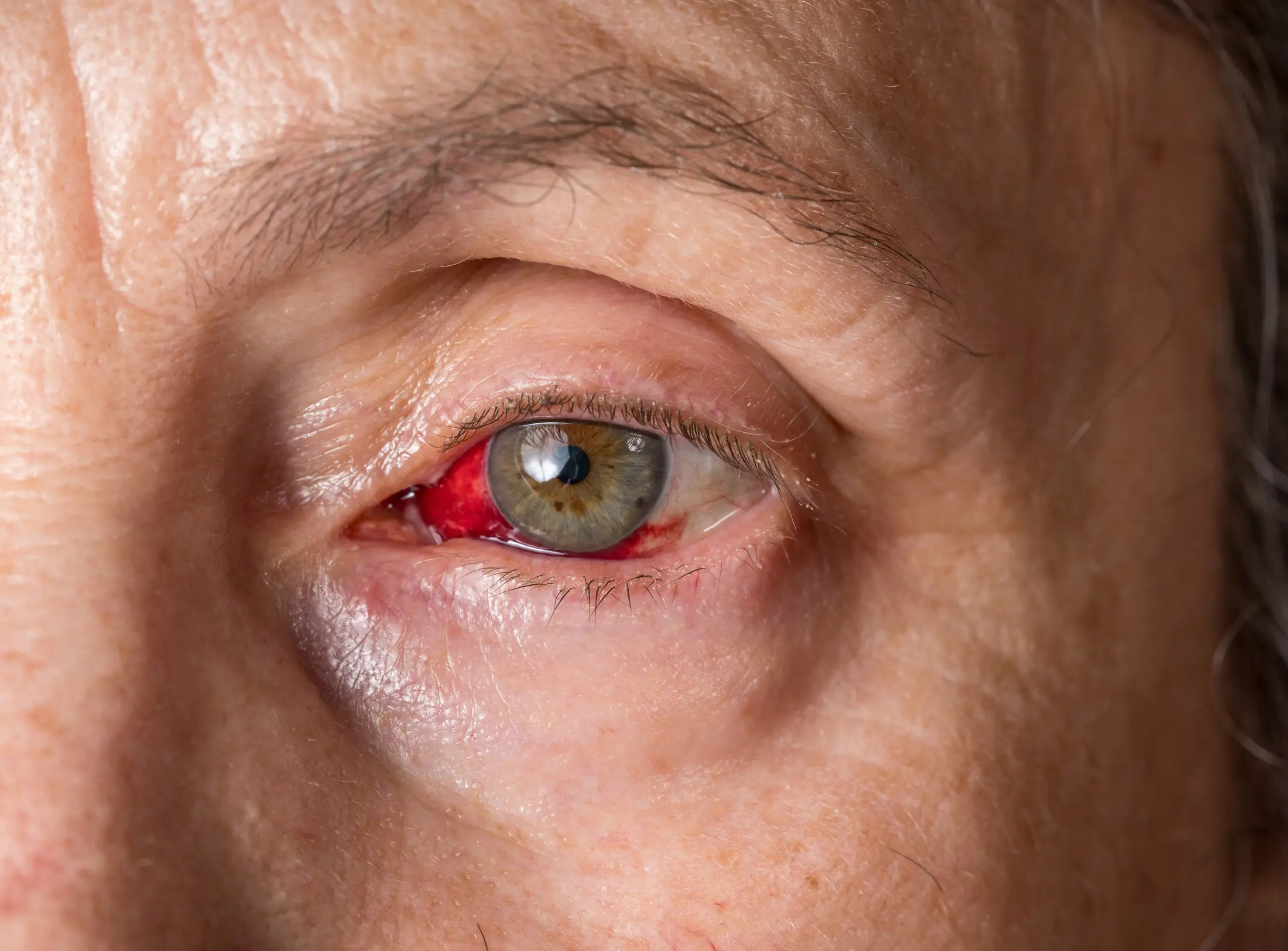 Red eye syndrome